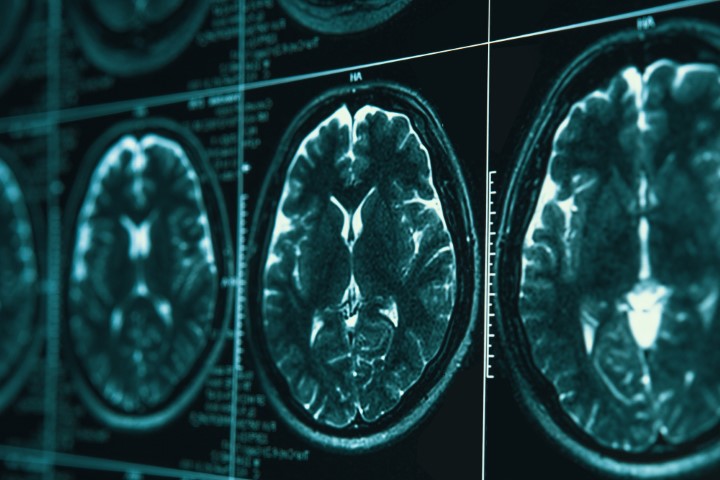 Work-related head and brain injuries can end your career