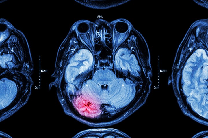 Traumatic Brain Injury After an Accident. Symptoms, Work Limits, and Compensation